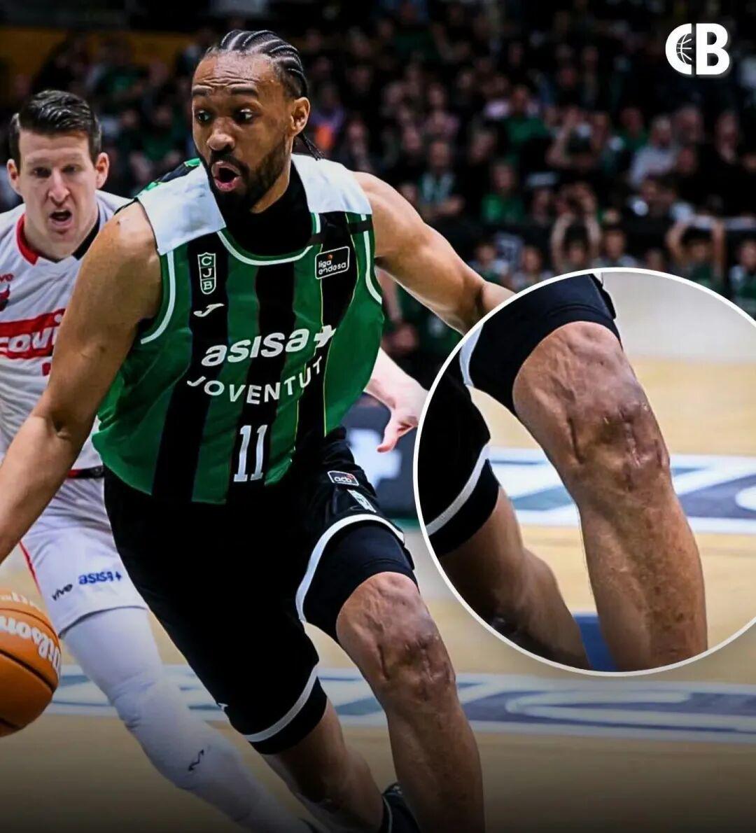 亿万28娱乐-好可怕的膝盖！两次ACL撕裂，他还在打球！！！